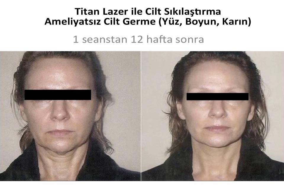 Non ablatif yüz genclestirmede Titan infrared lazer